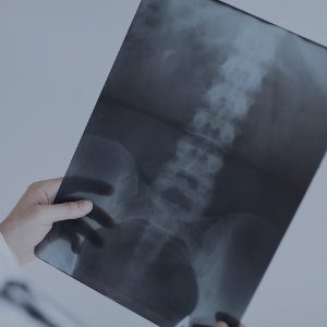 Image of spinal x-ray